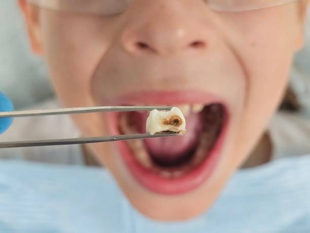 Best Emergency Treatment for Dental Infections or Abscesses in Denver, CO